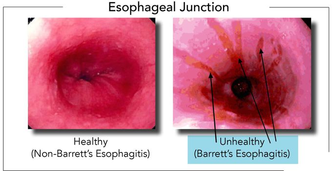 Barrett's Esophagus on endoscopy
