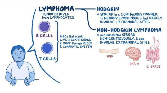 Hodgkin's lympnoma