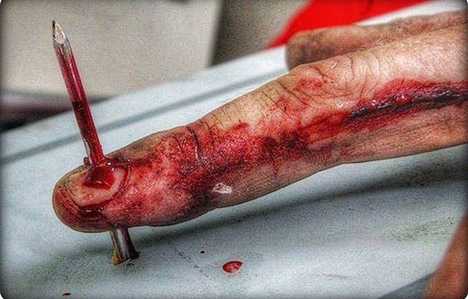 Traumatic Nail Gun Injury