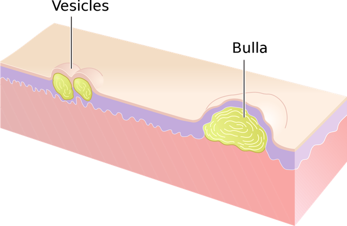 Vesicles vs bulla