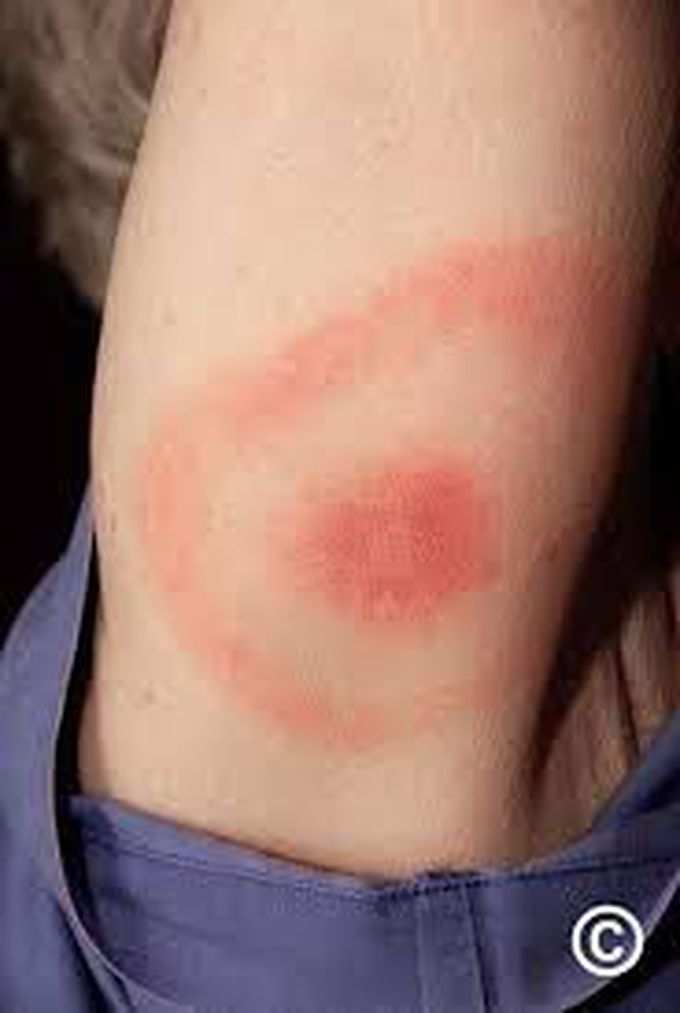 Erythema migrans