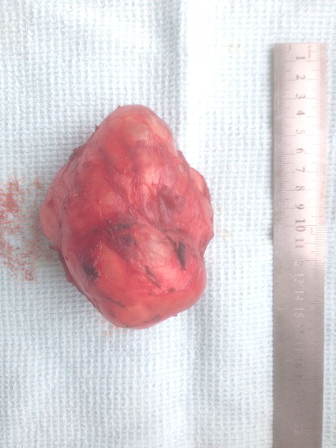 Cyst tumor
