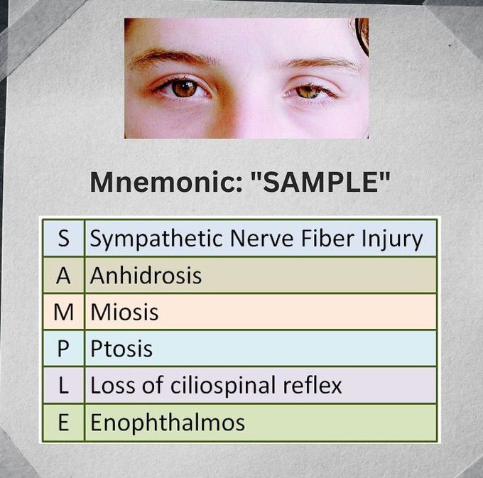 Horner Syndrome