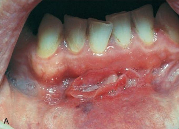 Crohns disease fissure