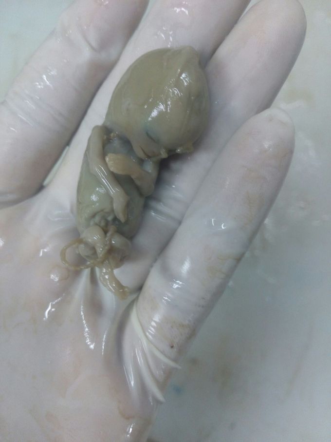 First trimester fetus