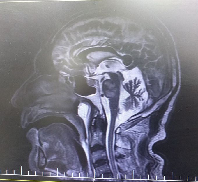 MRI dx?