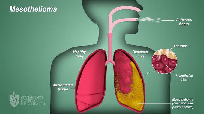 Mesothelioma