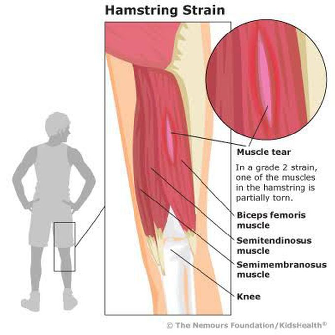 Hamstring strain