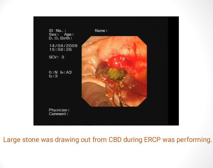 Therapeutic use of ERCP