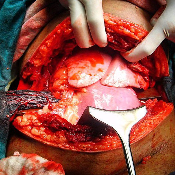 ABDOMINOTHORACIC TRAUMA DUE TO IMPALEMENT BY AN IRON BAR