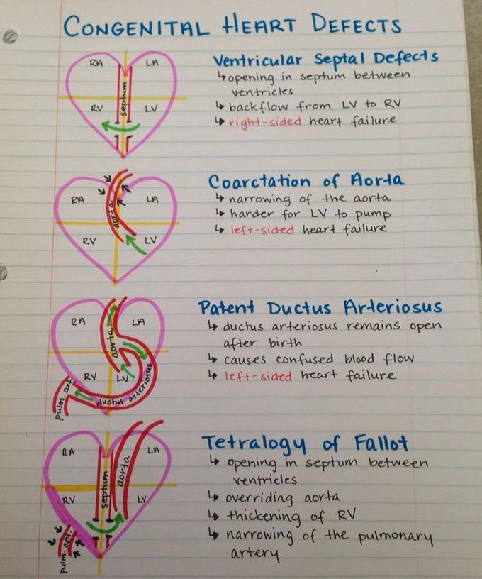 Congenital heart defects