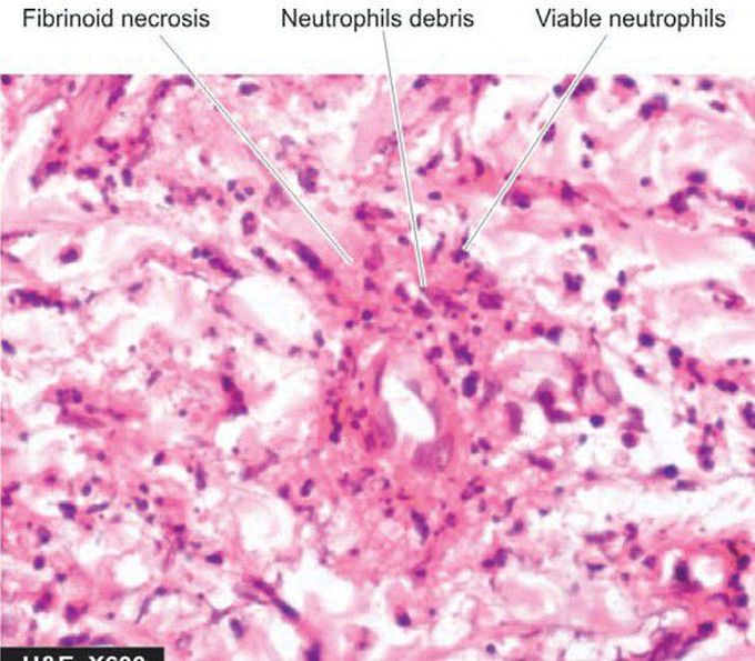 Leucocytoclastic vasculitis