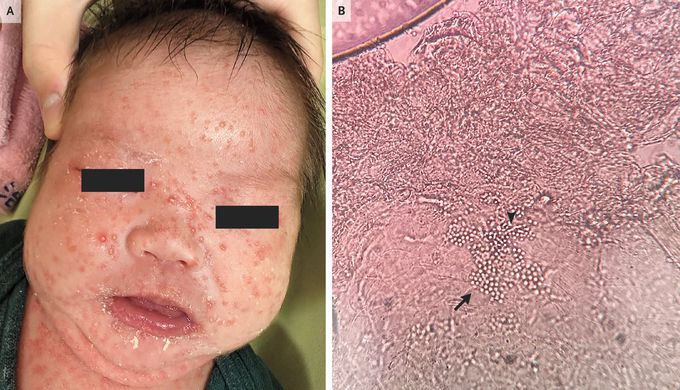 Neonatal Cephalic Pustulosis