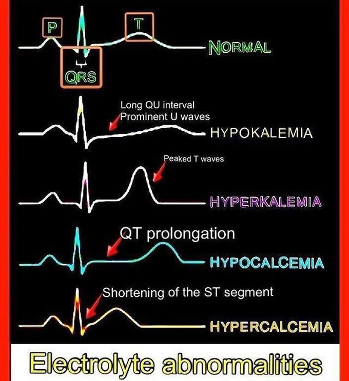 Electrolyte abnormalities in ECG