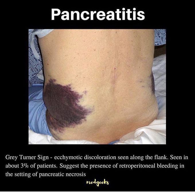 Pancreatitis