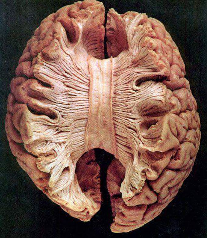 Corpus Callosum...