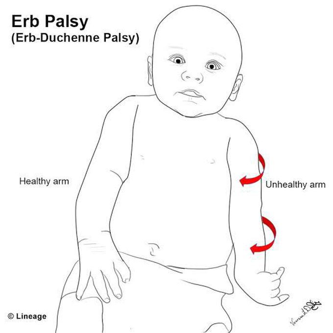 Erba Duchenne Paralysis
