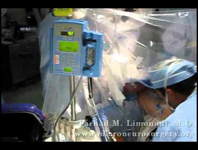Awake brain surgery (removal of glioblastoma multiforme, GBM)