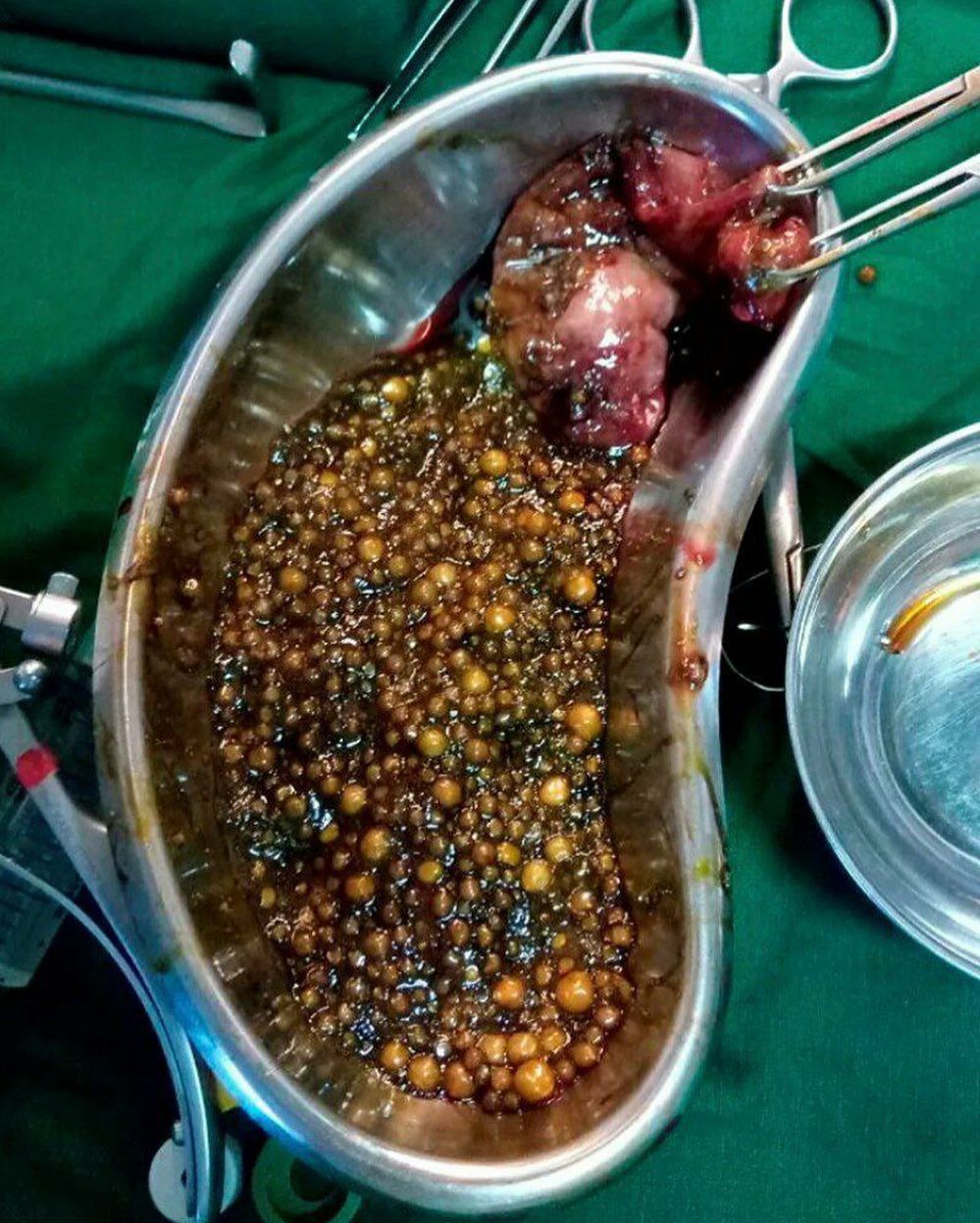 Real gallstones 2024