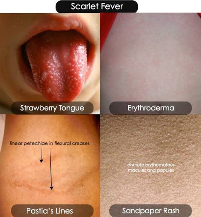 scarlet fever