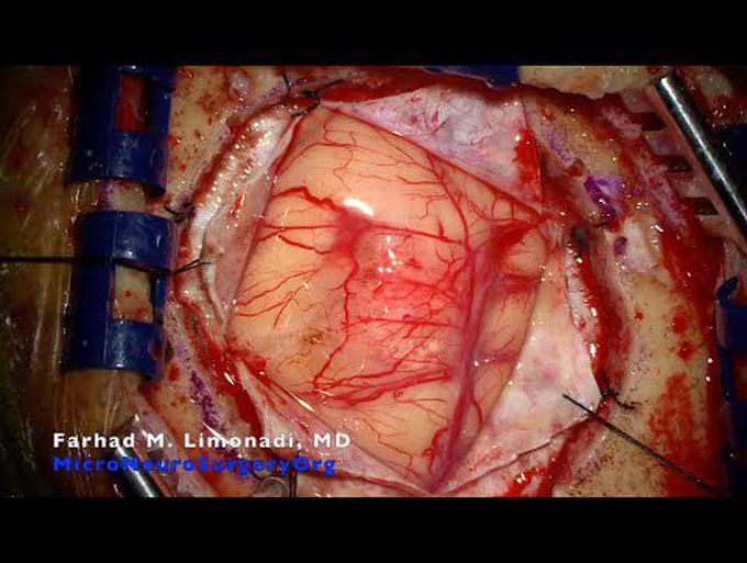 Metastatic lung cancer to the brain.  Case video presentation of surgical management.