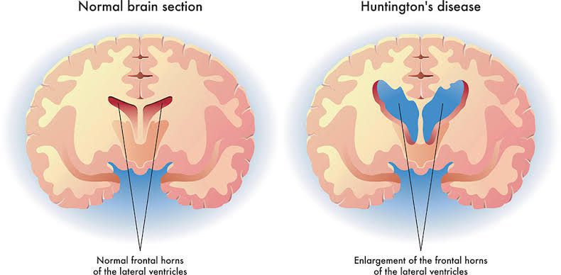 What Is Huntingtons Disease Medizzy 3234