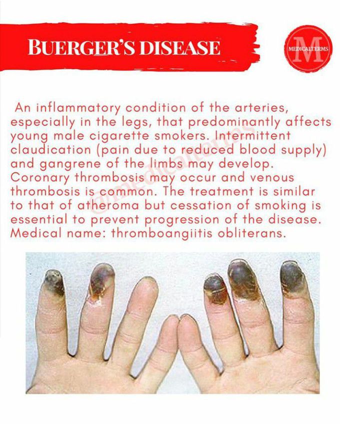 Burgers disease