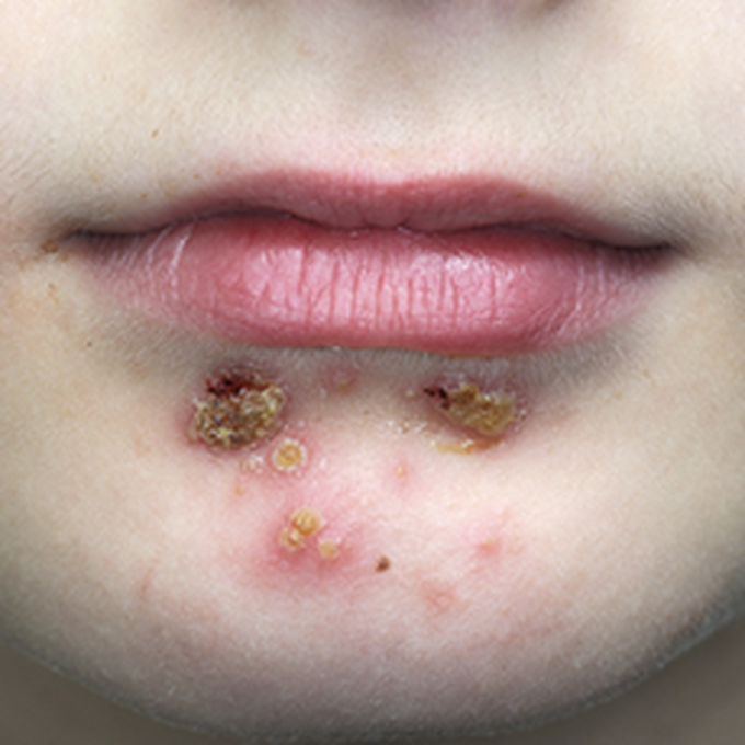 Impetigo