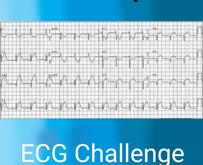 ECG challenge