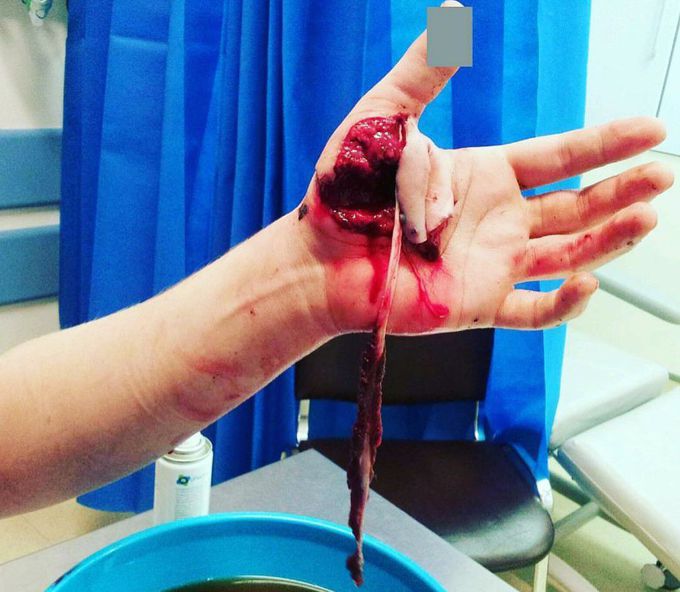 Injurious hand
