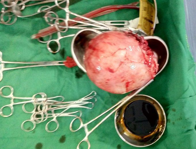 Fibroid uterus