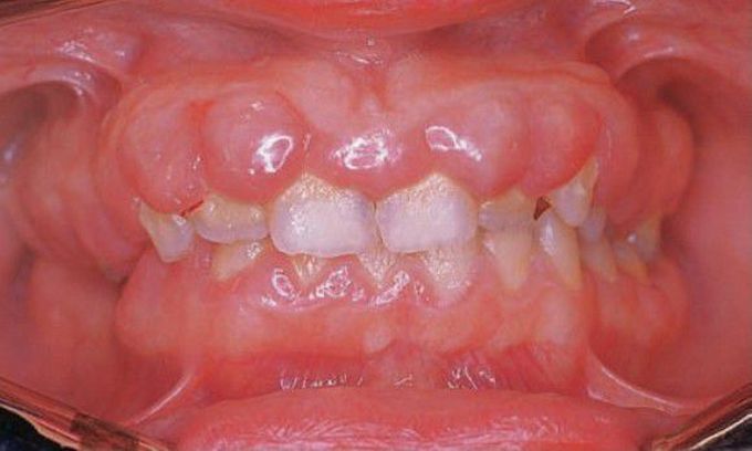 Generalized gingival hyperplasia