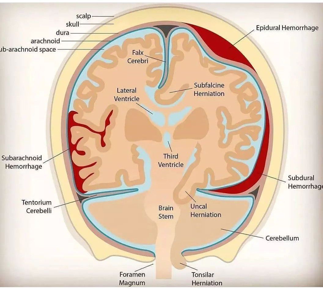 Intracranial Hemorrhage Medizzy