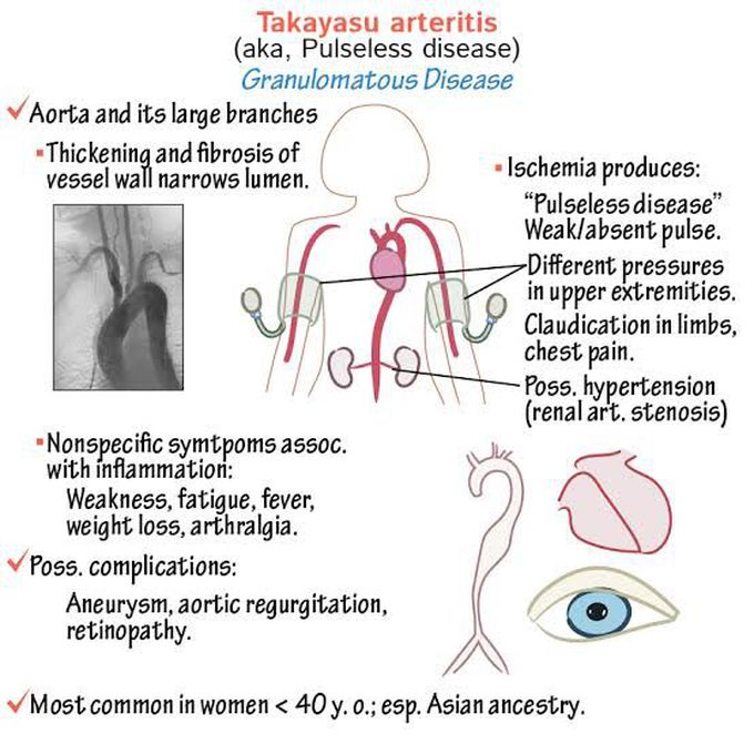 Takayasu Arteritis
