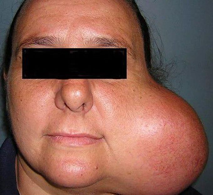 Pleomorphic adenoma