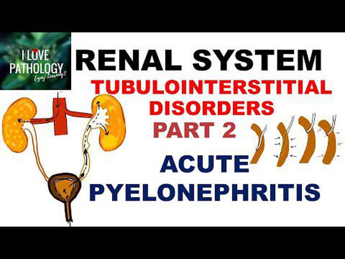 Acute pyelonephritis-Explained