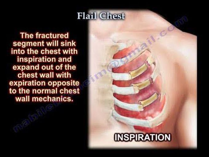 Management of Flail chest