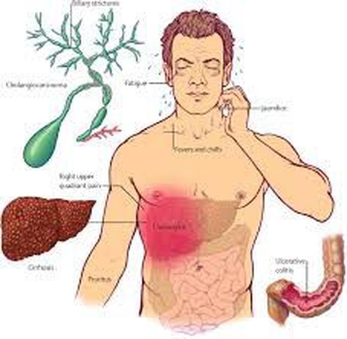 Symptoms of sclerosing cholangitis