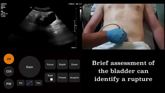 Ultrasound Tutorial: FAST (Focused Assessment with Sonography for Trauma) scan | Radiology Nation