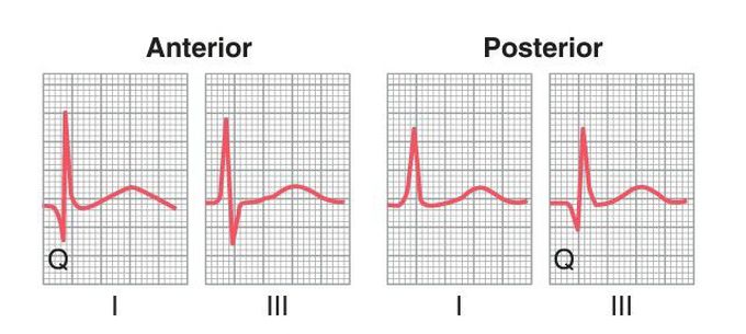 Anterior and posterior wall infarction