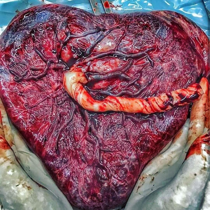 Human Placenta, the source of life.