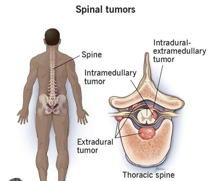 Spinal tumor