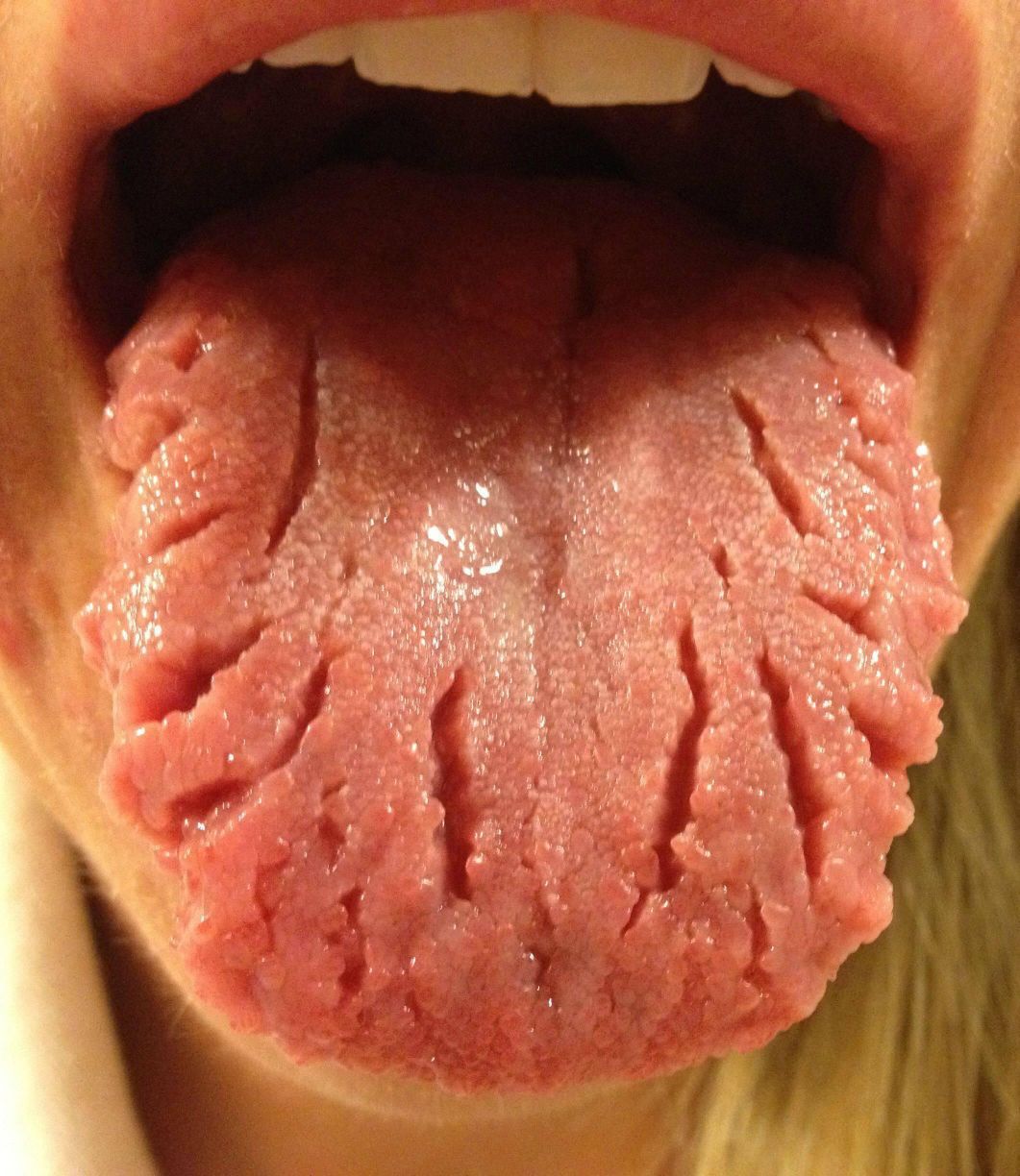 worst fissured tongue