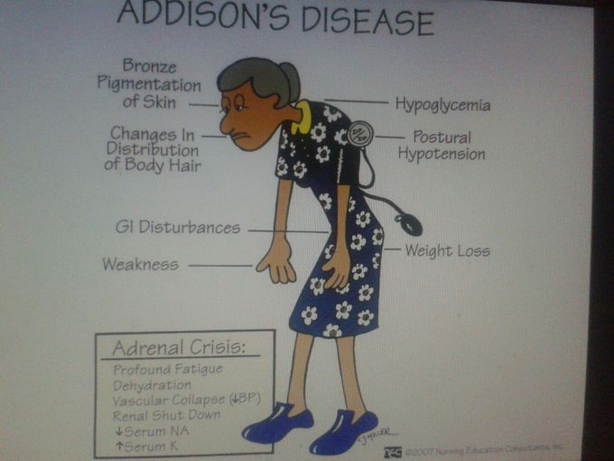 Features in Addisons disease