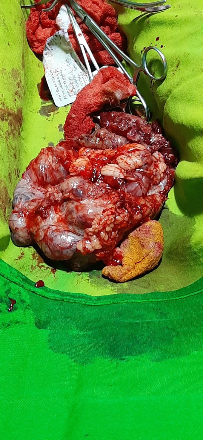 Retropretonial tumor