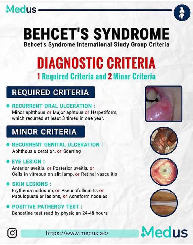 Behcet's Syndrome Diagnostic Criteria