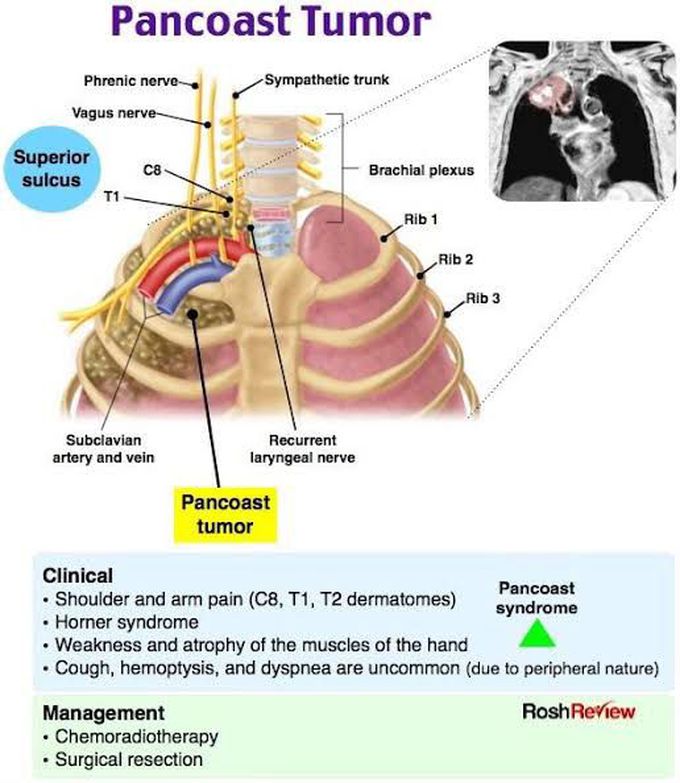 Pancoast tumor - MEDizzy