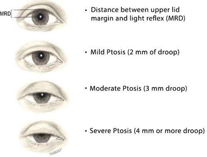 Ptosis