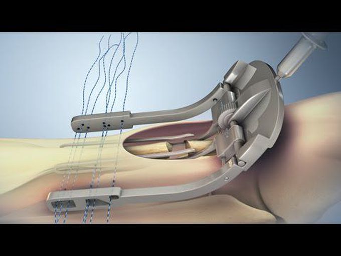 Achilles Tendon Rupture and Repair | Nucleus Health