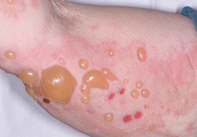 BULLOUS PEMPHIGOID